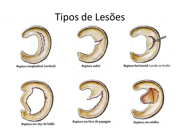 Tipos de Lesões no Joelho